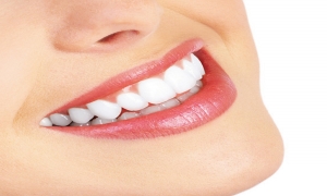 牙齒美白有哪些方式？樹脂美白、貼面美白和全冠各有哪些優缺點？